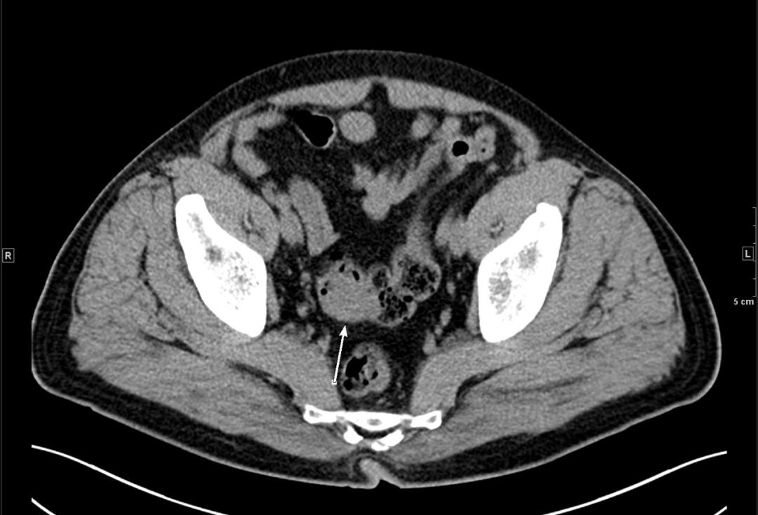 消化科医生开出这样一份结肠ct检查影像科直呼不敢做