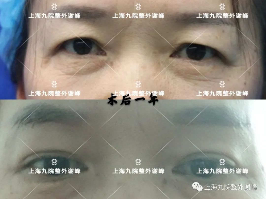 北京切眉手术 - 知乎