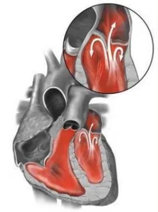 使得血液從左心室反向流入左心房,是由於二尖瓣瓣葉,瓣環,乳頭肌,腱索