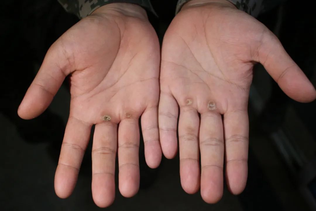 新兵身上的伤疤,你了解多少?