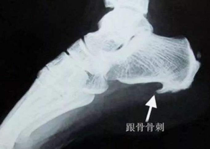 关节疼痛大多跟骨刺有关?这些锅,骨刺不背!