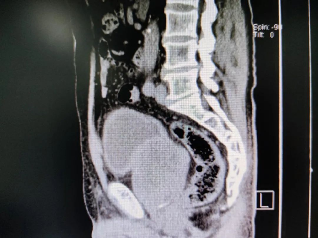 前列腺肿瘤petct图片