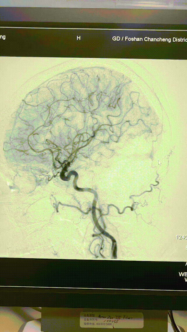 脑血管造影的三维图像