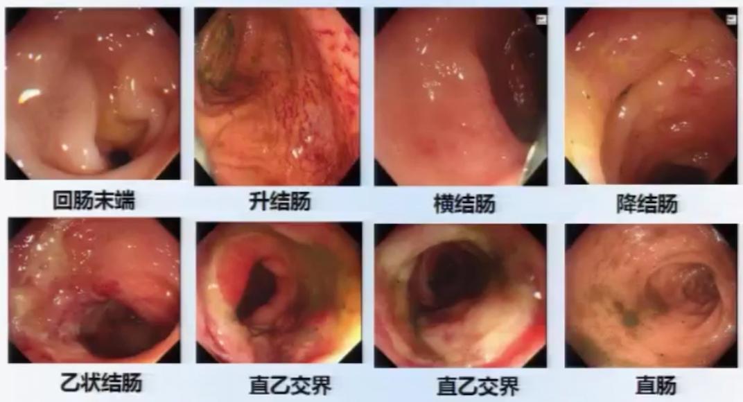 除了炎症性肠病和淋巴瘤结肠溃疡还要考虑这个病因