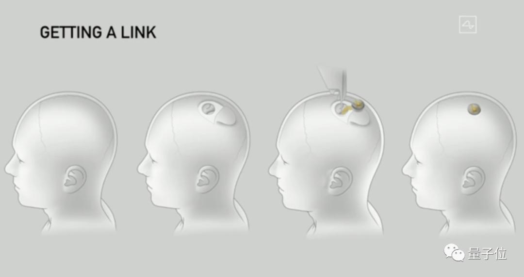 静脉植入脑机接口,无需开颅,人体实验已初步展开_科技_澎湃新闻-the