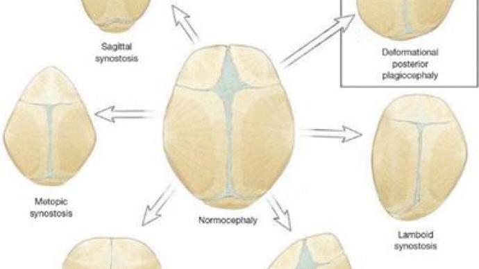 宝宝脑袋不好看？这5种头颅畸形要当心