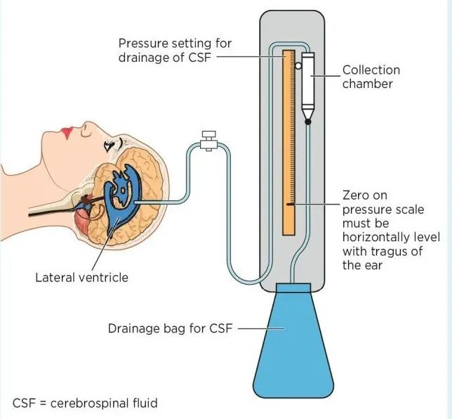 脑室引流示意图图片