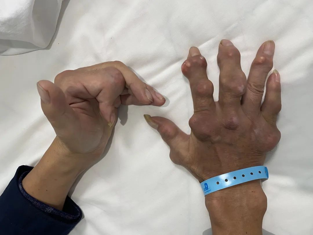 六院新闻早发现早治疗不容小觑的痛风正在吞噬你的生活