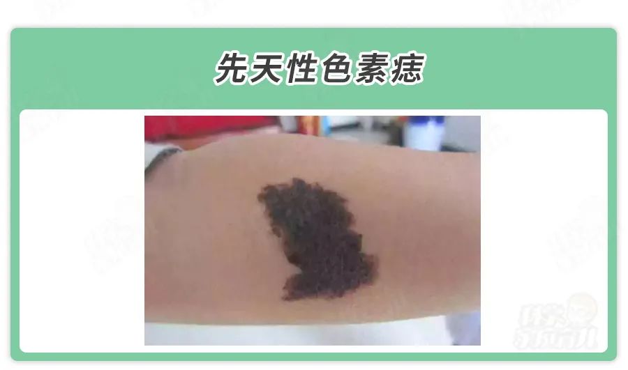 从发病到去世不到2月,这5种胎记和痣会危及娃生命_澎湃号·湃客_澎湃新闻-The Paper