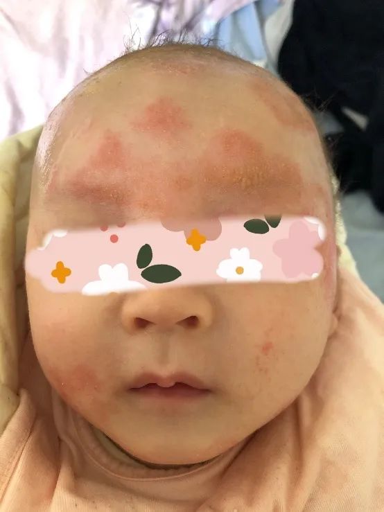 在临床上也称为婴儿期特应性皮炎,是由基因和环境等多种内外因素导致