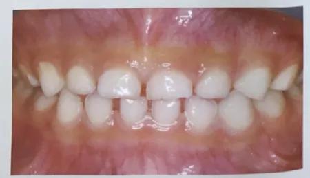 多数情况下,乳牙之间(特别是在乳前牙区)存在间隙,这是正常现象.