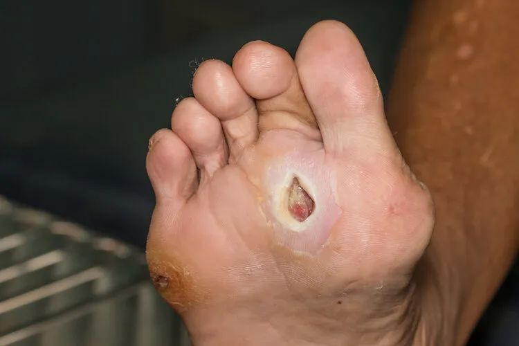 糖友出现这几个症状很遗憾是并发糖尿病足了