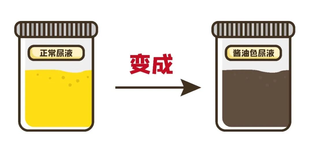 特色科普系列④市一腎內科醫生敲黑板橫紋肌溶解症和醬油尿瞭解一下