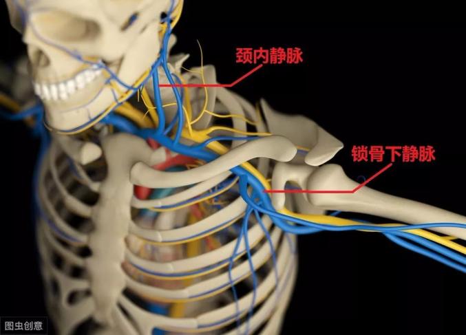 通常都需要打一个比较深的静脉(深静脉穿刺),比如打股静脉,锁骨下静脉