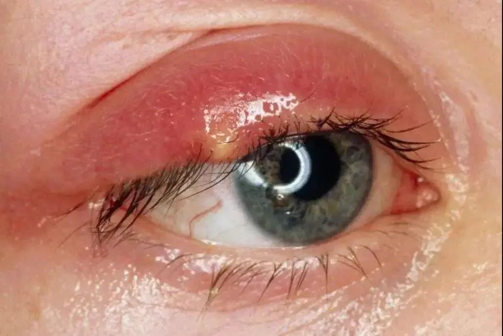 病毒性眼睑炎症状图片图片