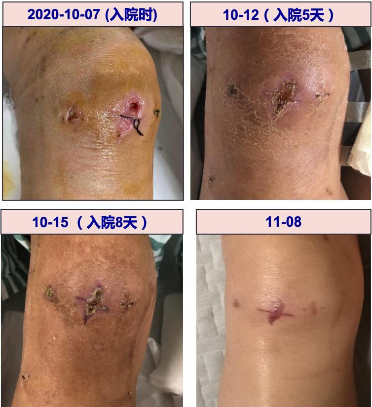 老年女性,右膝关节剔牙针刺伤后伤口红肿流脓,氨基糖苷类和头孢菌素抗