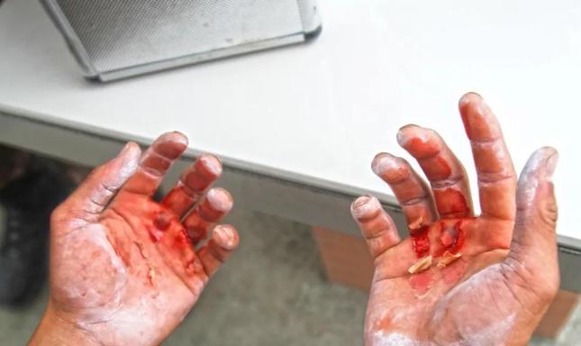 单杠卷身上102个!他的手让人心疼