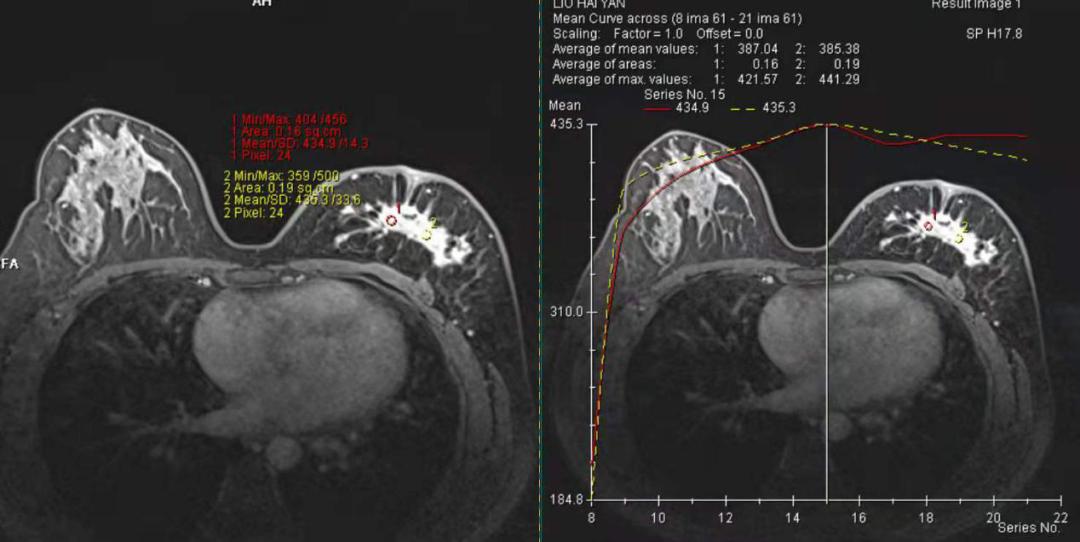 庐江女性福音 县医院开展乳腺mri