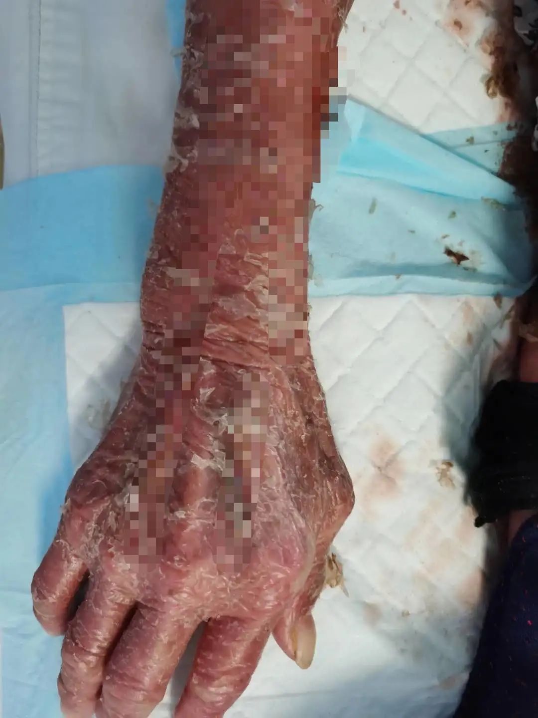 警惕七旬老人乖乖服药后像烧伤原因竟是儿子买错药