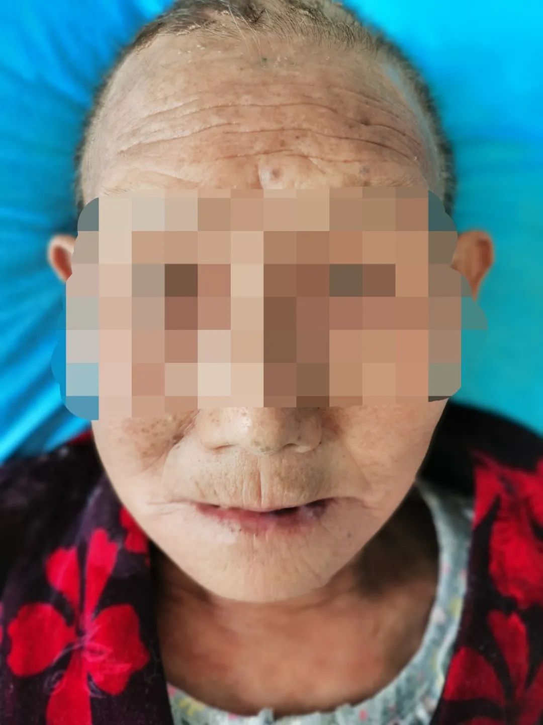 经过治疗,婆婆已经康复出院了"回去不要再把卡马西平当降压药吃了